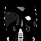 Transient hepatic attenuation difference, liver, THAD: CT - Computed tomography
